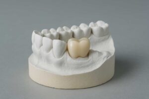 A dental model showcasing a provisional crown.