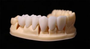 3D printed temporary crowns