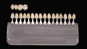 3D-printed-temporary-dental-crown