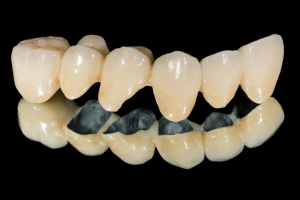 dental-casting-model