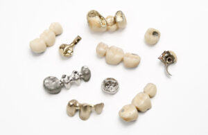 Different types of dental restorations such as porcelain - fused - to - metal crowns, metal crowns, dental bridges and metal dental components