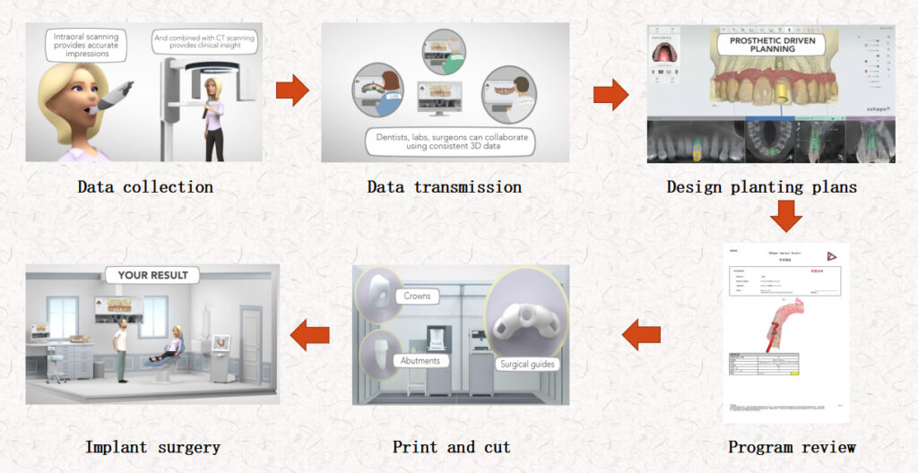 digital-workflow-of-3D-printed-dental-implanting-guides