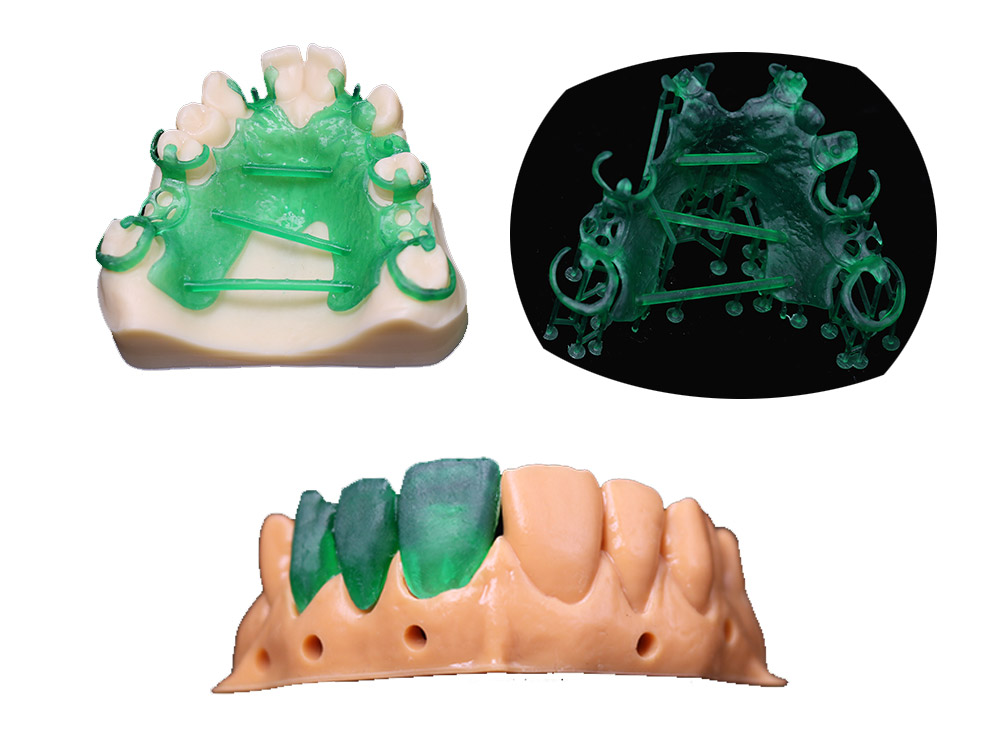 3D casted crowns and bridges | Dental 3D Printing Solutions