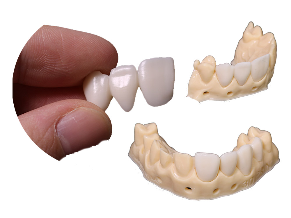 3D printed temporary crowns| Dental 3D Printing Solutions