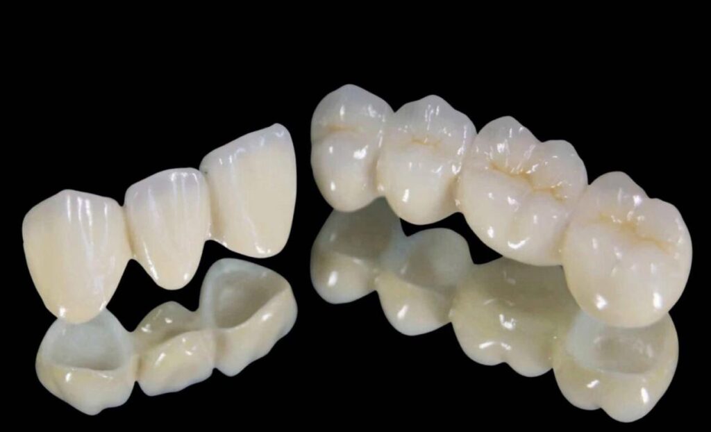High-quality full porcelain crowns with natural - looking color and texture, showcasing excellent aesthetic and dental restoration properties.