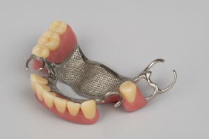 Removable partial denture model. Restores missing teeth, with artificial teeth for function, pink baseplate like gum, and metal clasps for fixation.