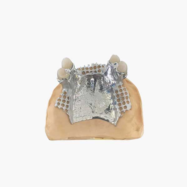 A shiny, finished cast metal removable partial denture framework with integrated teeth, perfectly fitted on a dental model.