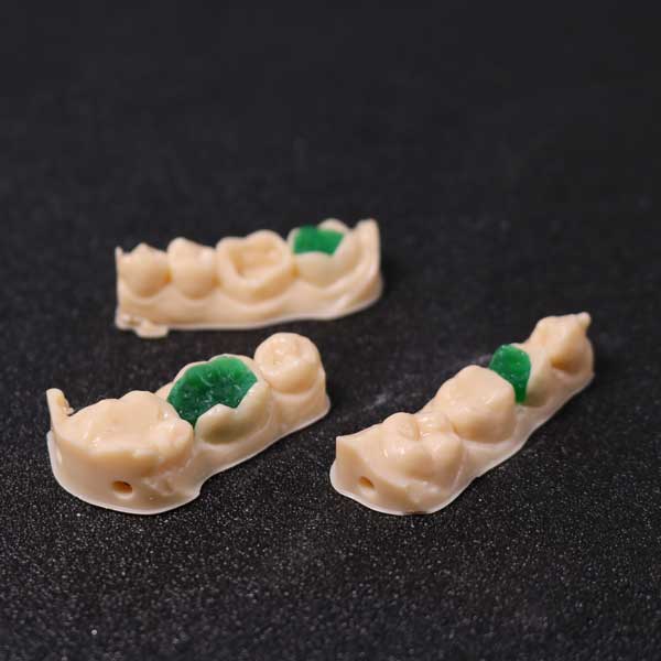 Three dental models with green 3D printed resin inlay and onlay patterns perfectly fitted into the prepared tooth cavities, demonstrating extreme precision.