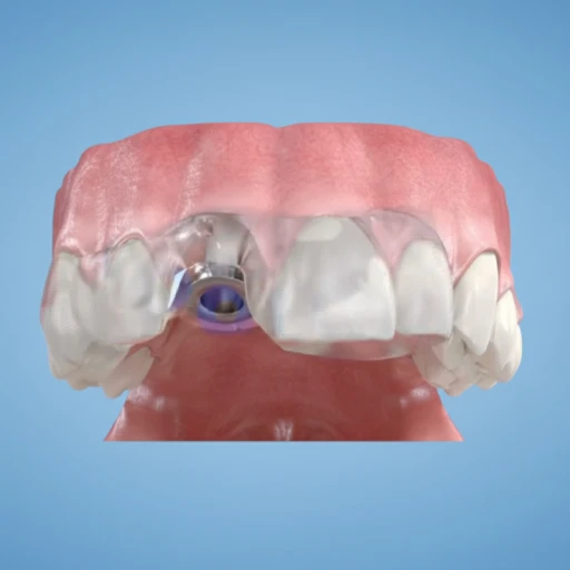 3D rendering of a dental implant being placed using a transparent 3D printed surgical guide.