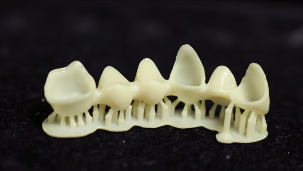 Detailed view of the internal surface and marginal precision of a 3D printed bridge using 3180 permanent resin.