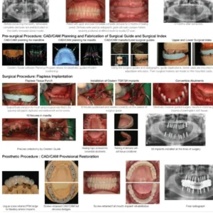 Full Arch Implant Workflow using CAD/CAM Surgical Guides and 3D Printed Temporary Bridge